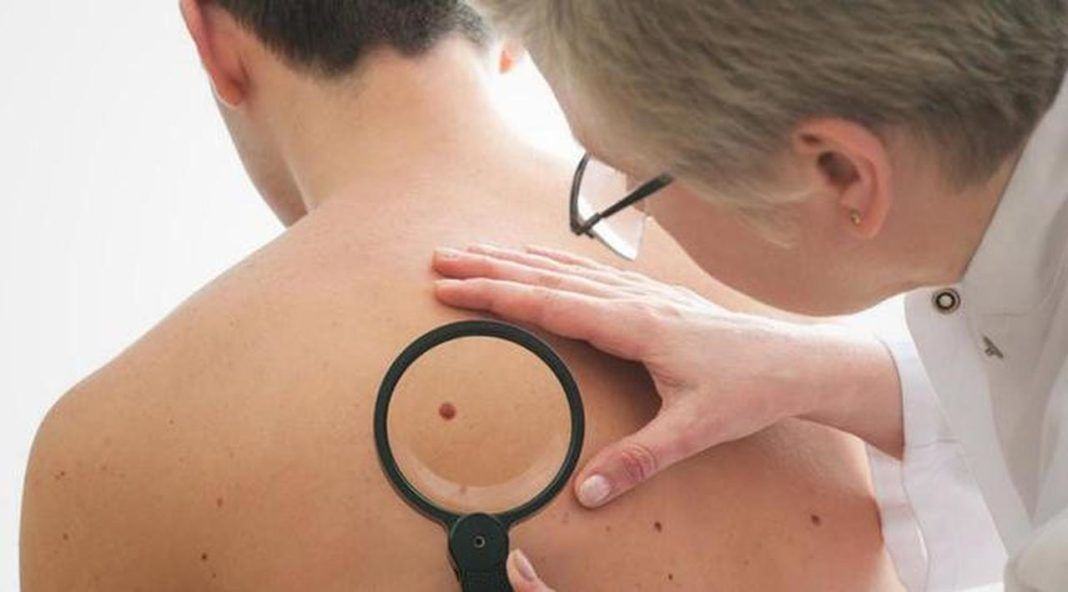 Ternyata letak tahi lalat pada tubuh kita memiliki arti dan makna yang dapat mencerminkan kepribadian seseorang. (Foto: iStockphoto)