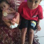 Dua Anak Mandailing Natal, Butuh Bantuan Biaya Berobat ke Rumah Sakit