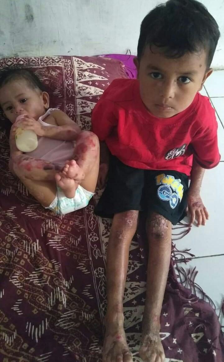 Dua Anak Mandailing Natal, Butuh Bantuan Biaya Berobat ke Rumah Sakit
