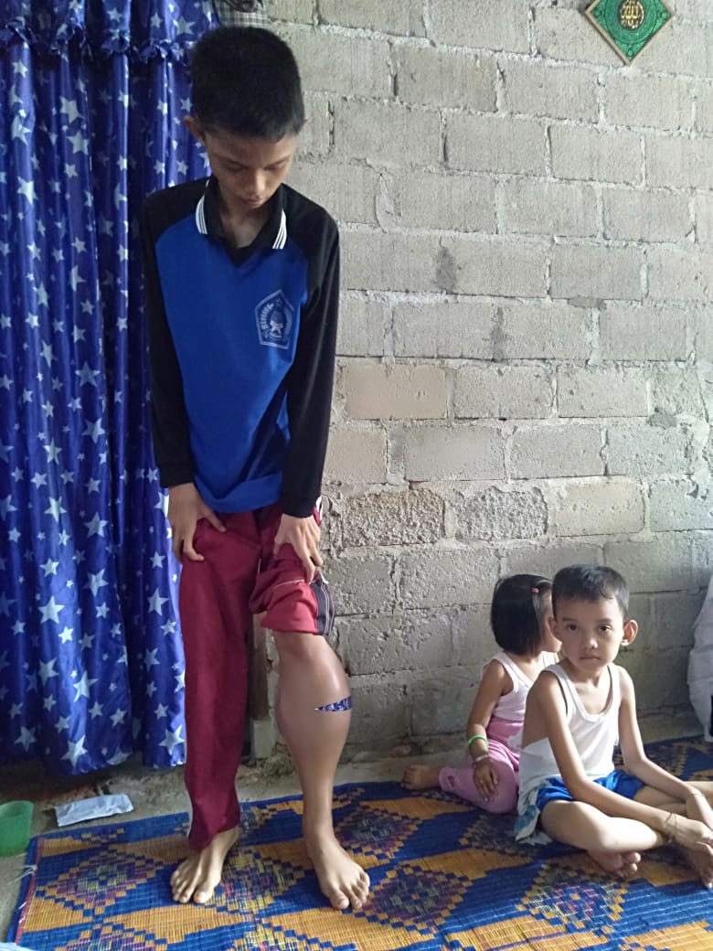 Penderita Kanker Tulang di Asahan, Muhammad Nabil Butuh Pertolongan (2)