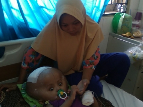 Penderita Hidrosefalus di Batu Bara, Tidak Direspon Pemerintah Setempat