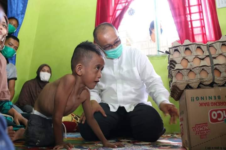 Akhyar Kunjungi Yuda, Anak Penderita Kelainan Fisik Sejak Lahir