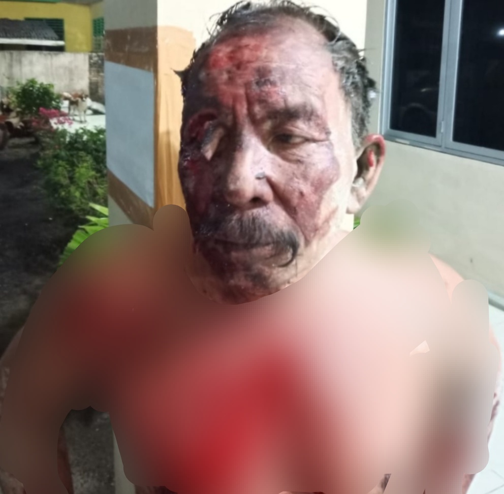 Seorang Warga Sergai Pelipisnya Dihantam Gelas, Gara-Gara Rebut Mikropon Karoke di Kedai Tuak